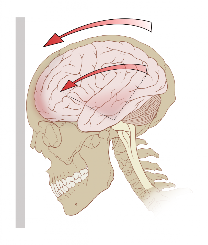 1200px-Concussion_mechanics.svg